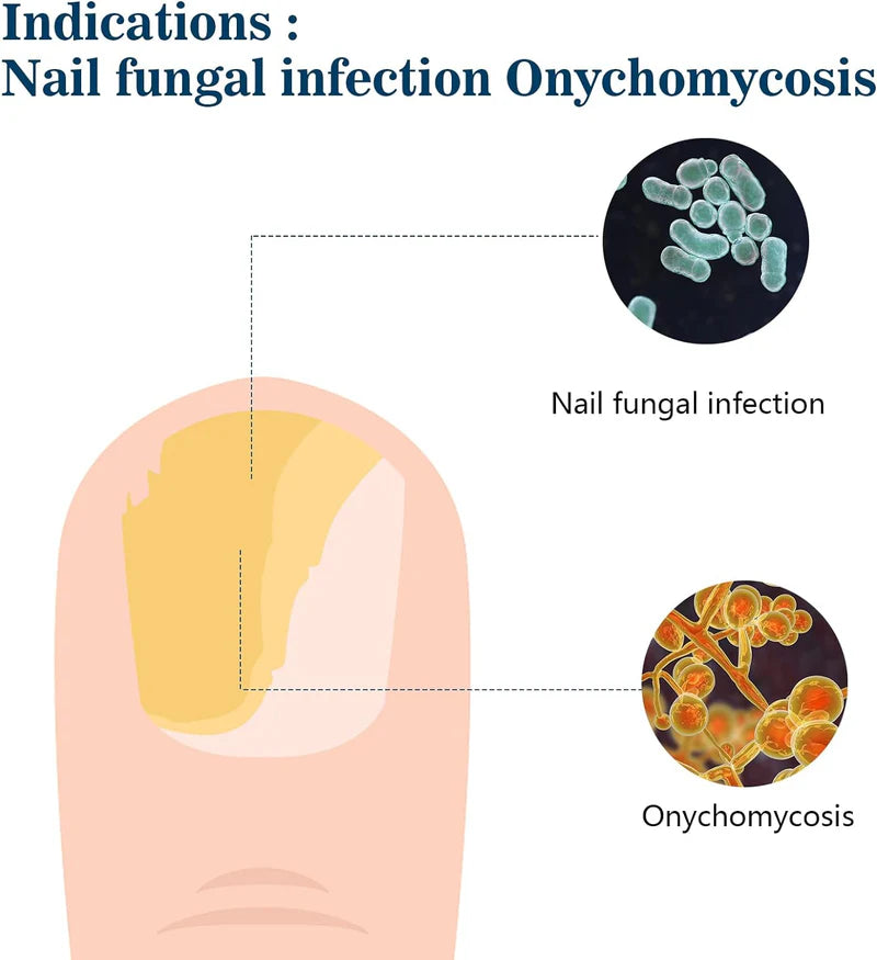 KTS Nail Fungus Cleaning Device - Onychomycosis