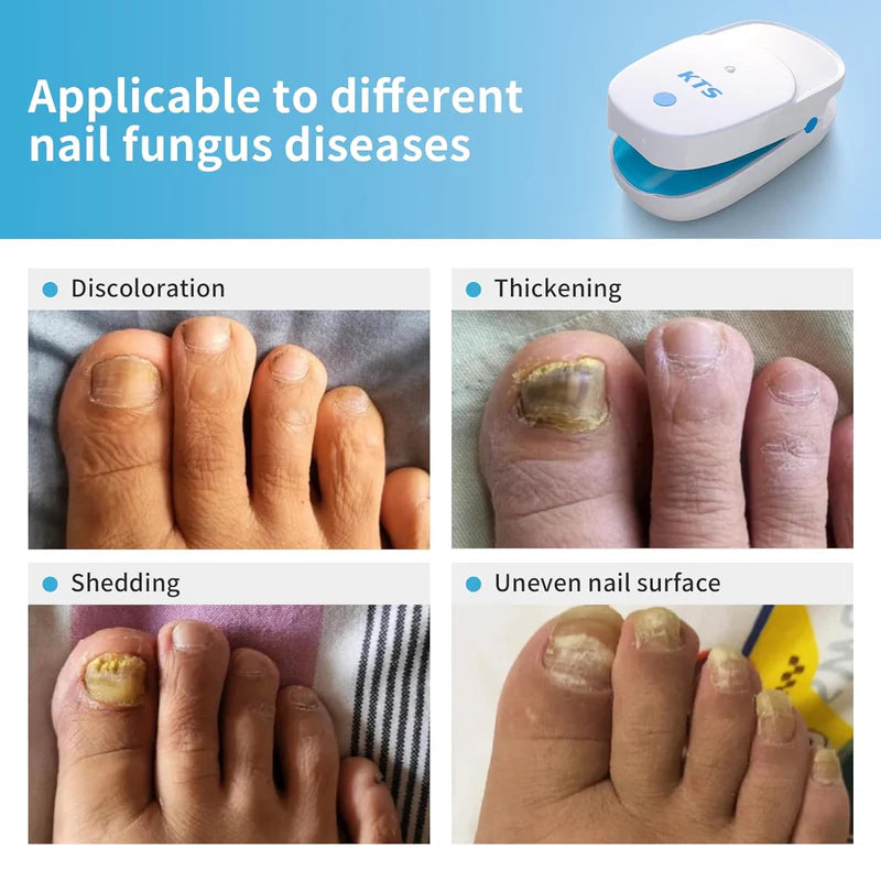 KTS Nail Fungus Laser Treatment Device