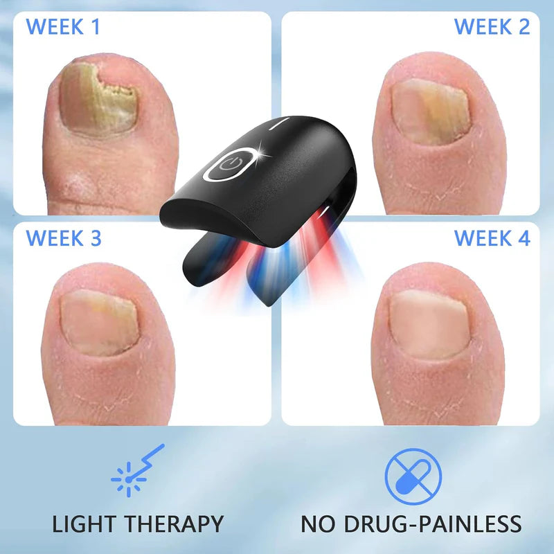 KTS Nail Fungus Cleaning Device for Onychomycosis