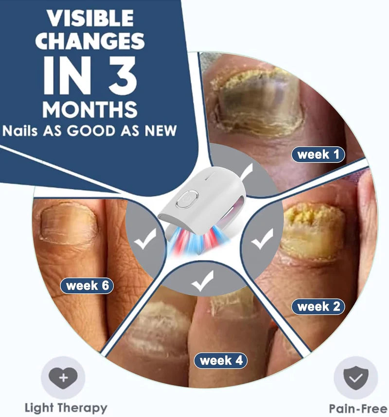 KTS Nail Fungus Laser Therapy Device