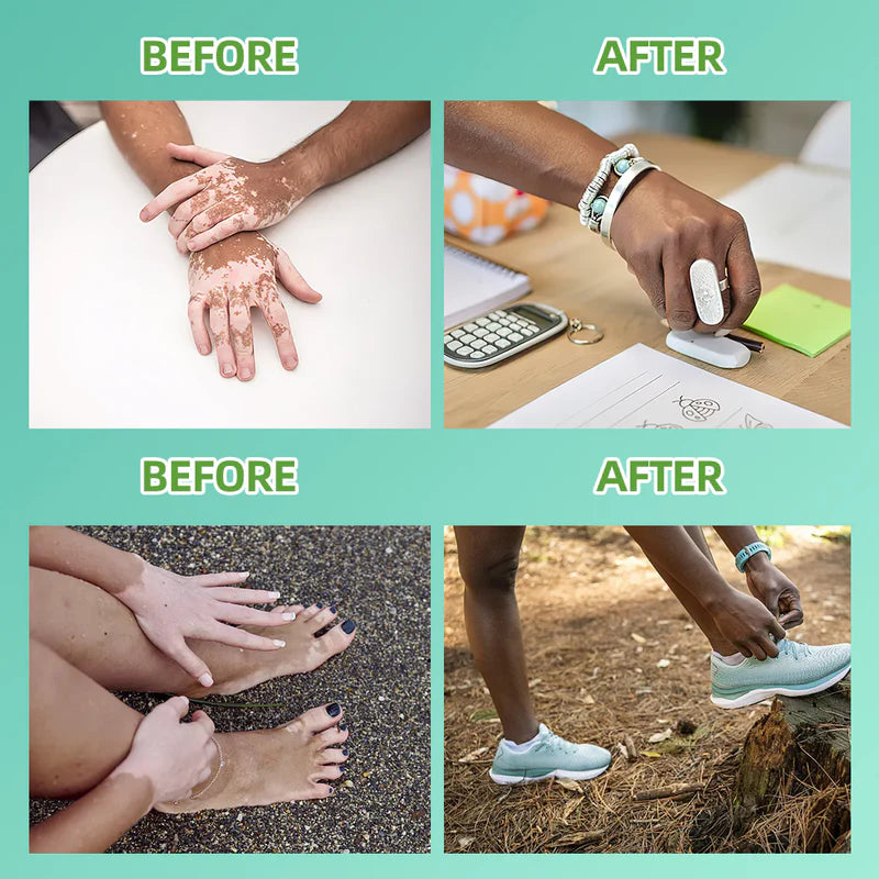 Philips Narrowband UVB Vitiligo/Psoriasis Light Therapy Device